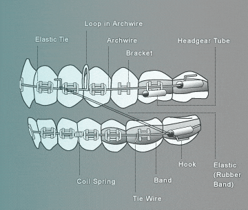 An application scenario or product detail of difference between a tie vs bracket - Image 1