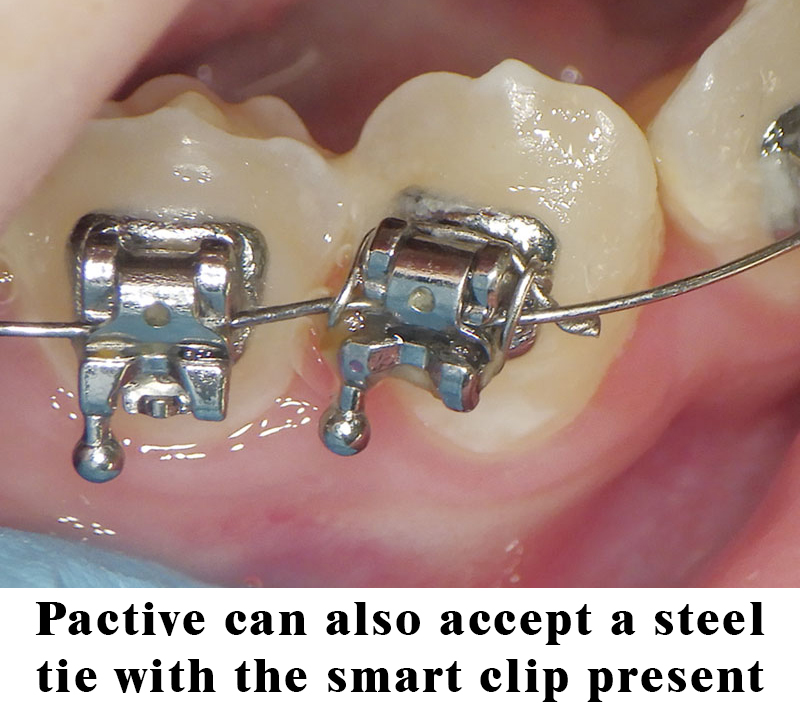 An application scenario or product detail of difference between a tie vs bracket - Image 15