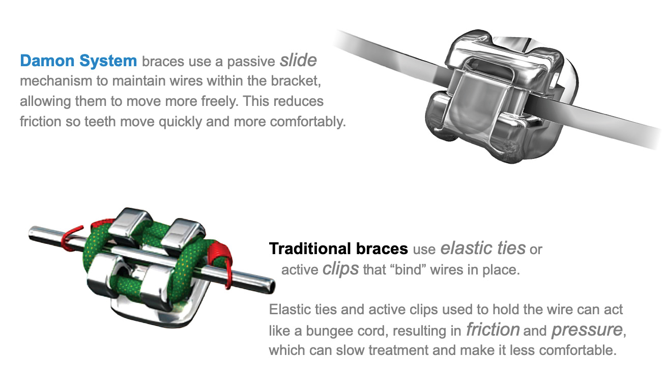 An application scenario or product detail of difference between a tie vs bracket - Image 18
