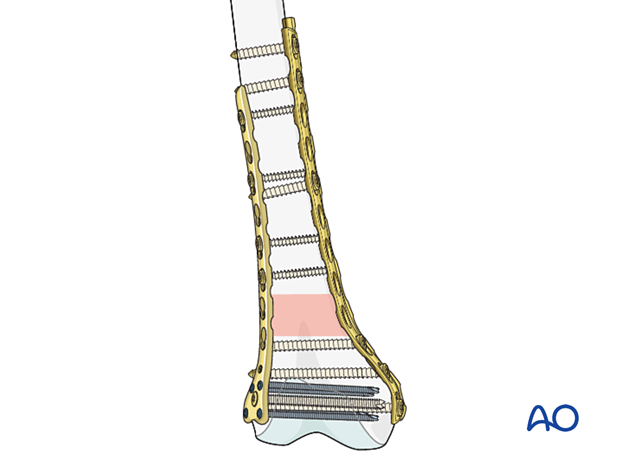 Featured image for the double plating guide