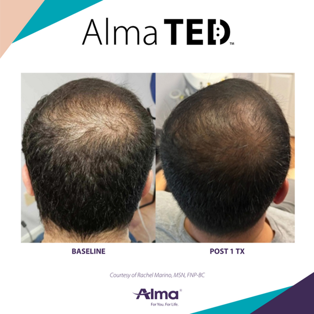 An application scenario or product detail of ted hair - Image 1