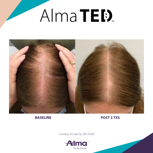 Featured image for the ted hair guide